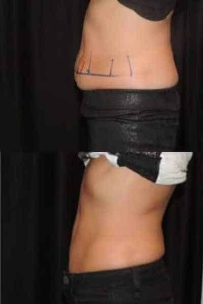 HIEMT Muscle Toning Stourbridge