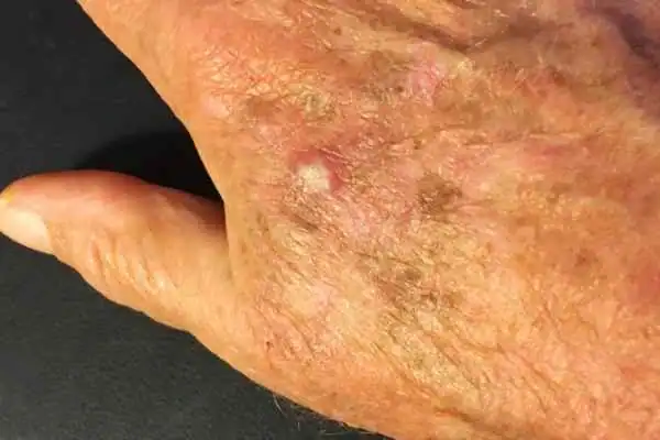 Cryopen For Actinic Keratoses 1 Image of Actinic keratoses Stourbridge on a person hand