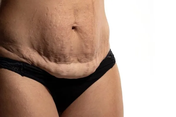 The science behind skin tightening Stourbridge picture of a woman's sagging skin on the stomach
